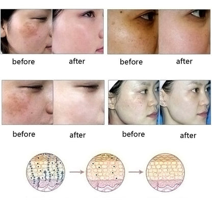Dredge Meridian Skin Care Natural Pure Removal Acne Stretch Marks Scar Remova